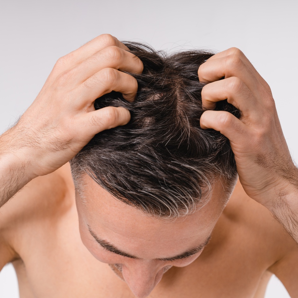 Brown-haired handsome man showing his hairline for some dandruff shirtless isolated over white background