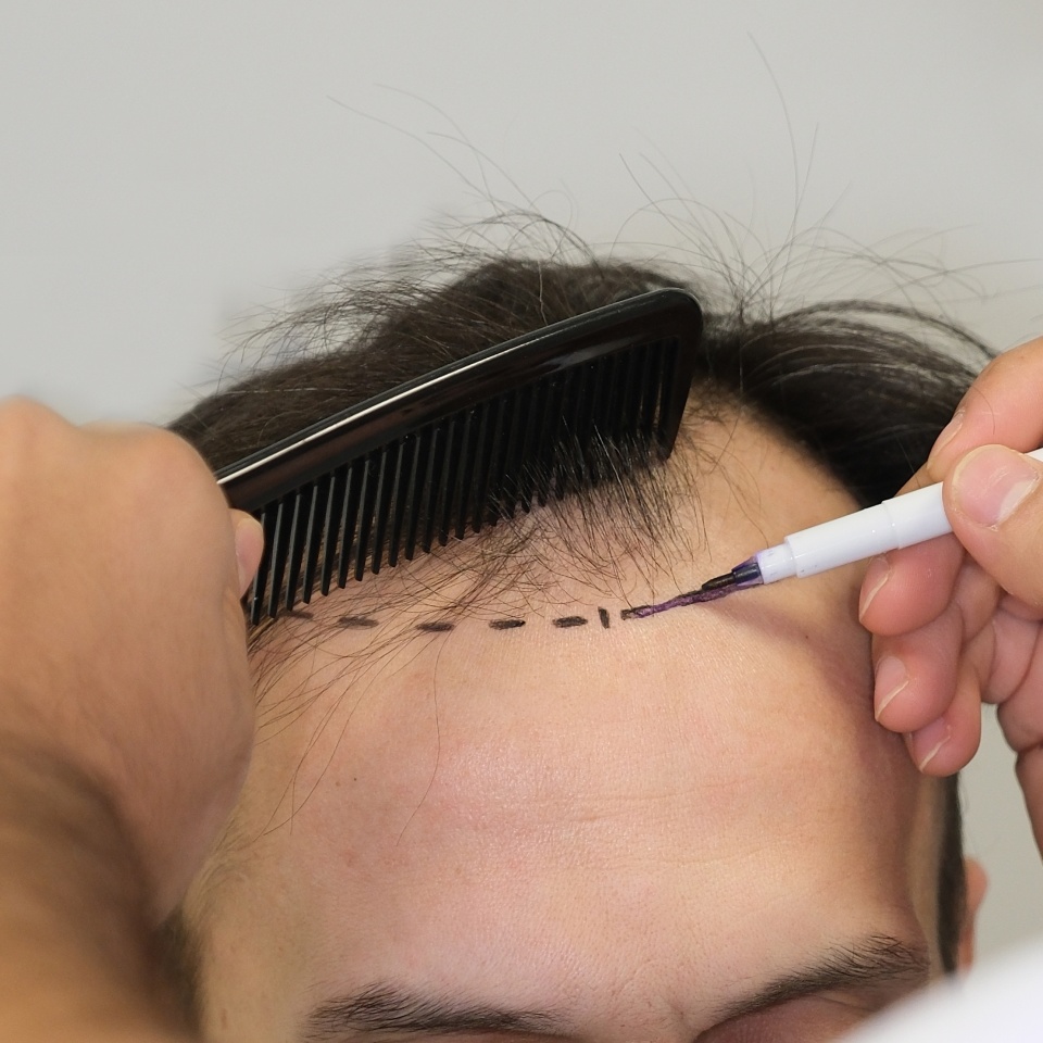 hair transplant man women fue dhi sapphire hair care