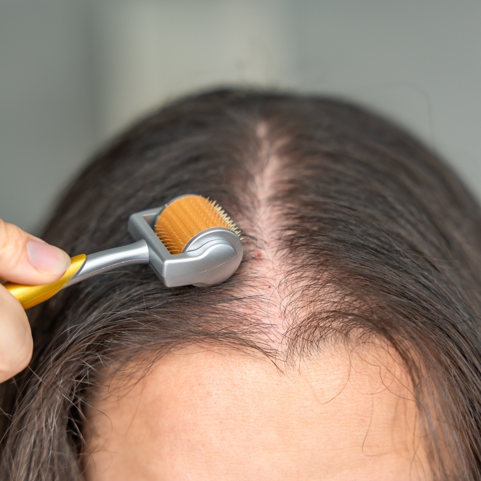 Close up view of young woman using microneedle derma roller on head for stimulating new hair growth in home. Treatment for the healthy scalp. High quality photo